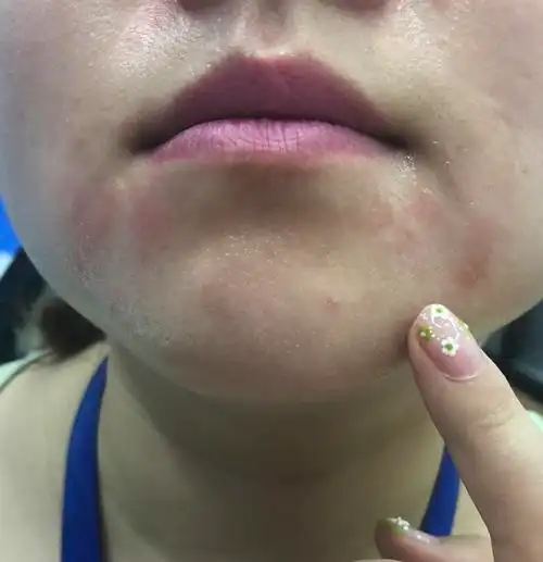 在京东自营买的丸美护肤品导致皮肤过敏联系客服迟迟处理无果