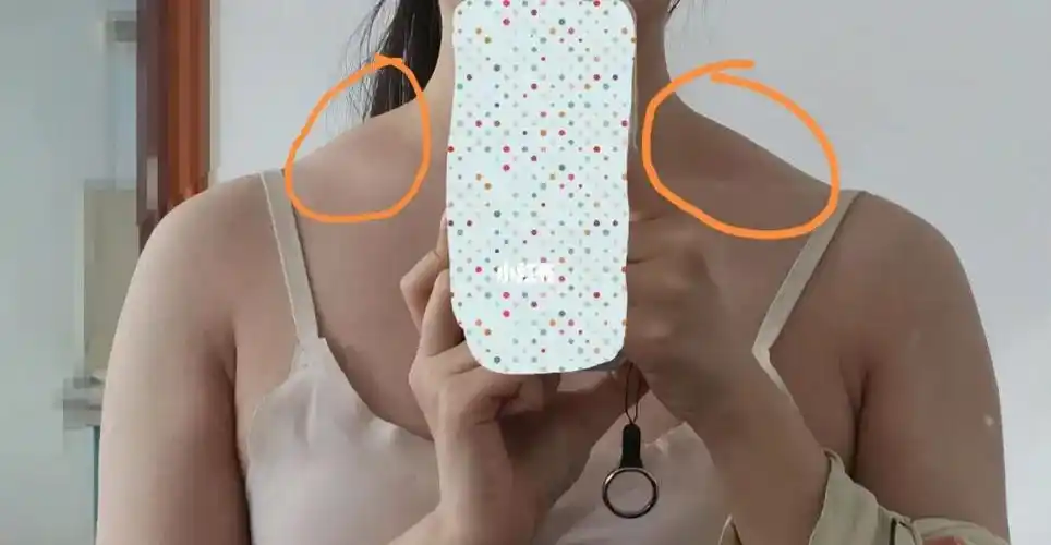 斜方肌特别肿大,脖子也粗,还有救吗姐妹们我其实只有一百斤,但是看着