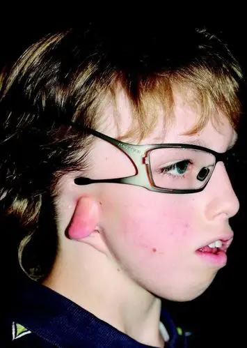 没有耳朵怎么戴眼镜呢?_小耳畸形 - 好大夫在线