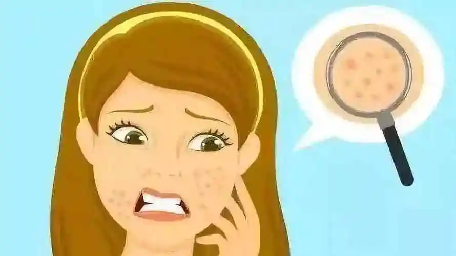 皮肤毛孔大怎么办皮肤毛孔大有粉刺黑头怎么办