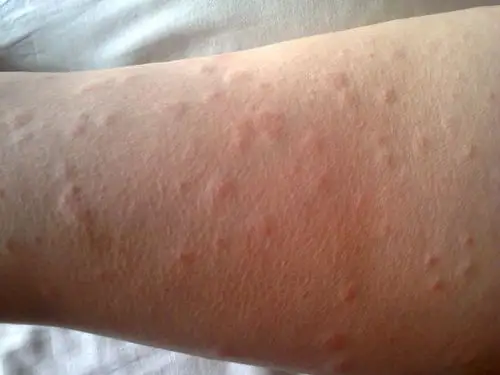 身体一受热就起痒疙瘩原来是胆碱能性荨麻疹惹的祸