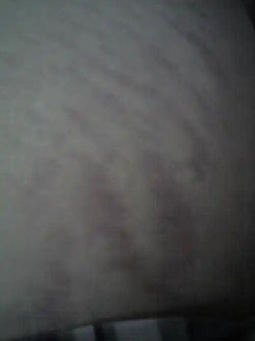 大腿根红色发暗,凹陷不规则条文,不疼也不痒,有一年多了,希望专家诊疗