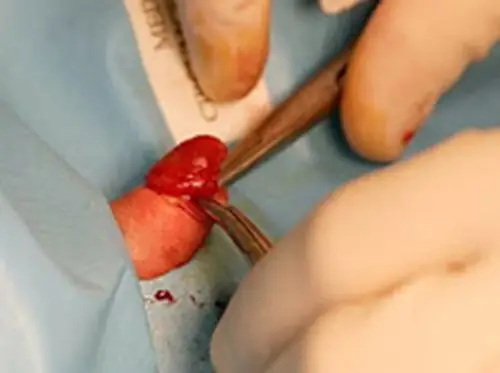 香港包皮过长医院_香港治疗包皮过长哪家医院好_香港