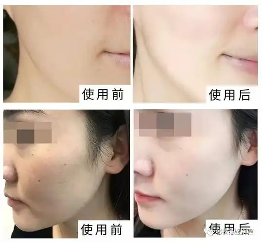 韩国小鲸鱼面膜补水真假对比鉴别