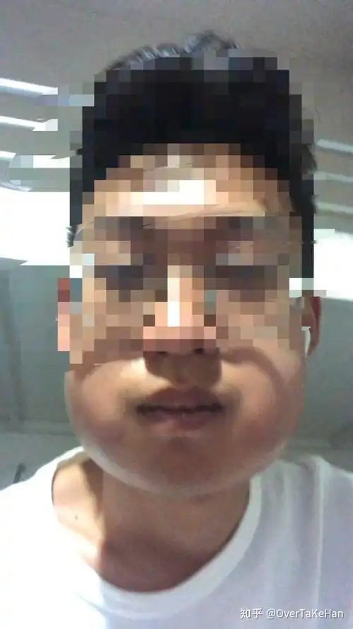 拔智齿脸都要肿成这样么?