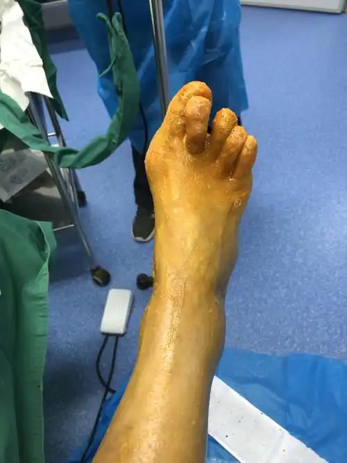 拇外翻手术术前准备