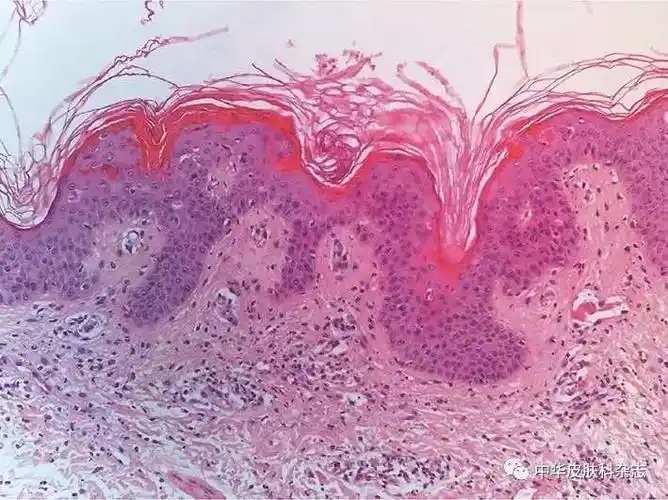 点状角化过度,表皮增生肥厚,棘层上部散在坏死角质形成细胞,真皮浅