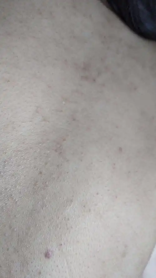 后背部大片痘痘是痤疮还是马拉色菌毛囊炎