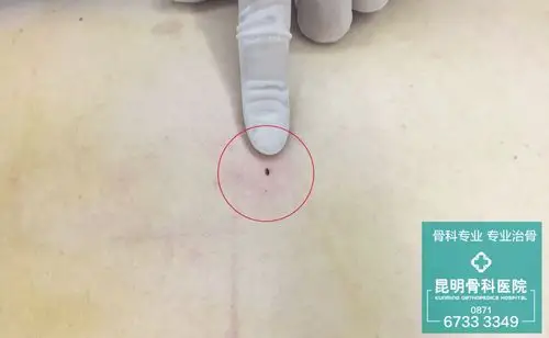 昆骨微创"一针"缓病痛!