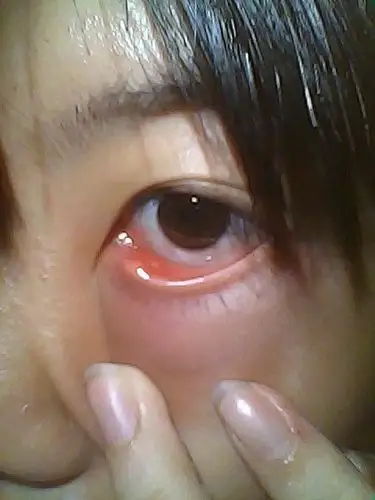 周四时下眼睑疼痛,周五整个眼袋红肿疼痛,下眼睑长了个红包,下