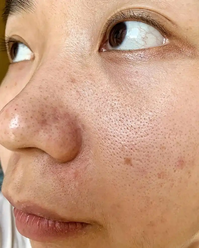 医美科普挑战赛#  毛孔粗大是很多人面部皮肤的困扰之一,给人带来不