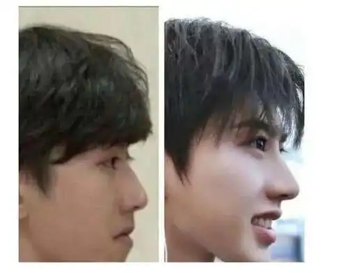 当时蔡徐坤一直在矫正牙齿,嘴巴里一直戴着牙套,所以才会显得脸和下巴