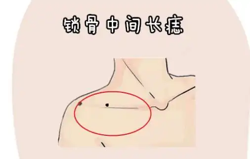 锁骨中心长痣