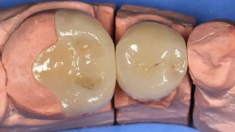 金赛美学铸瓷嵌体修复病例(四)