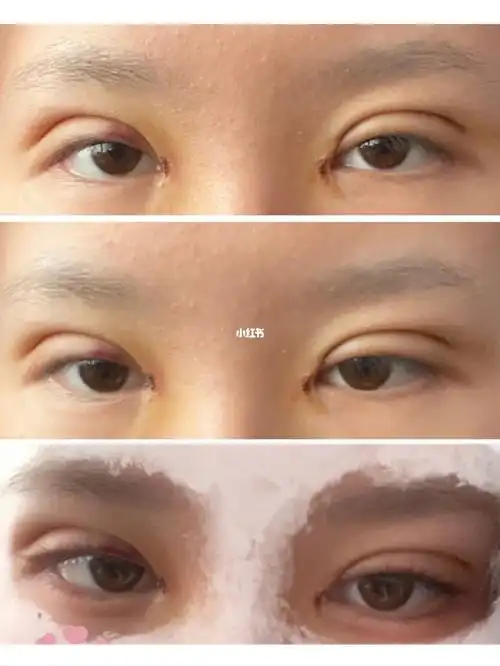 埋线双眼皮77开眼角_开眼角_埋线双眼皮_刘亦菲_美妆_医美整形