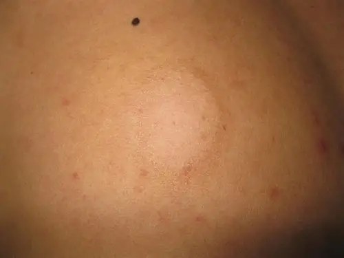 看图识病--------白色糠疹