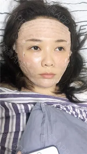 自体脂肪全脸填充第1天