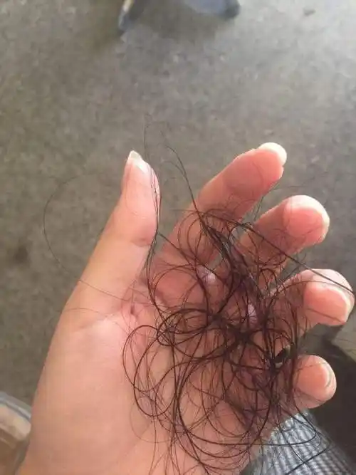 脱发|掉发|血液循环|皮脂腺_网易订阅