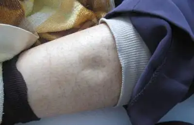 肾炎性水肿的简介