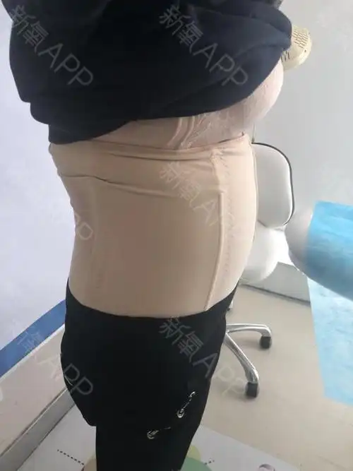 今天是我做完腰腹环吸的第7天,今天去医院拆线了,给大家分享一下术后