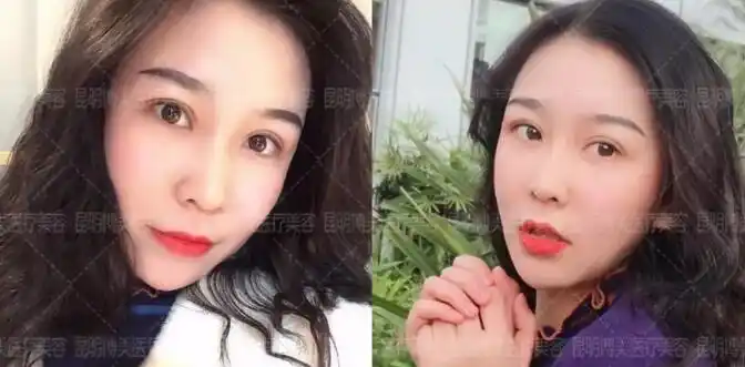 5s重睑术案例对比单眼皮与双眼皮的较量