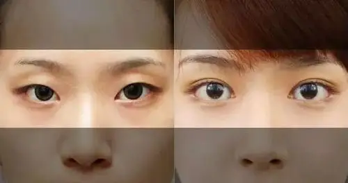 "下睑下至"如何应对"吊眼"?