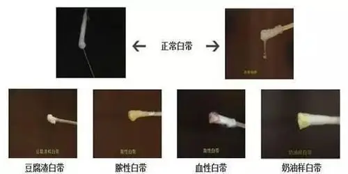 排尿障碍伴白带增多:典型淋菌感染症中白带与尿道分泌物一样为量增多