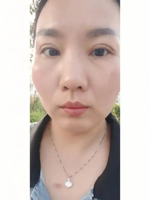 三点定位双眼皮第21天