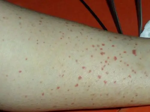 男性一期梅毒图片49