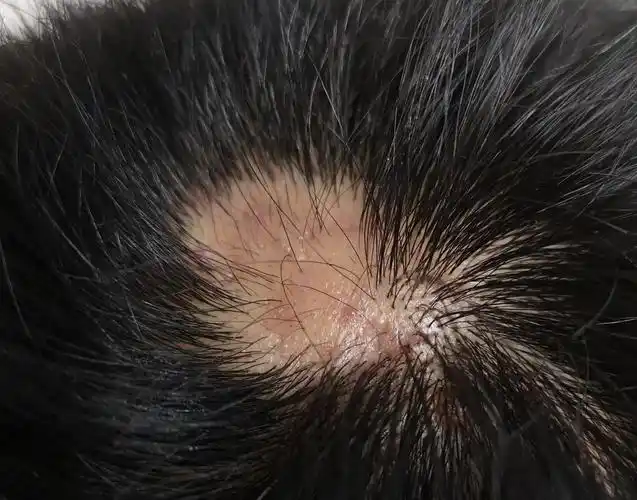 令人抓狂的头部毛囊周围炎