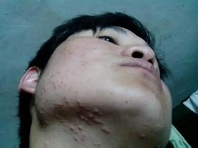 阴茎长毛囊炎的症状图片