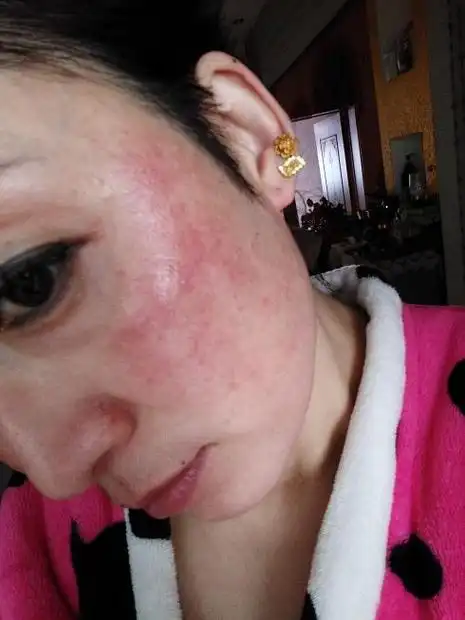 皮肤过敏泛红怎么办 皮肤过敏泛红缓解方法-蜀川星座网