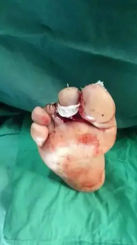 诊间微雕大师亮绝活足趾离断成功救活