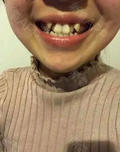 我这个虎牙和大门牙太难看了
