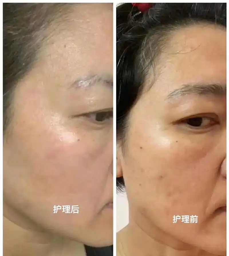 顾客做完一次的美白效果,肤色提亮,祛黄美白前后对比#同城美业 - 抖音