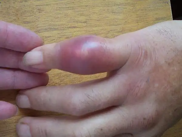 手指痛风的症状图片