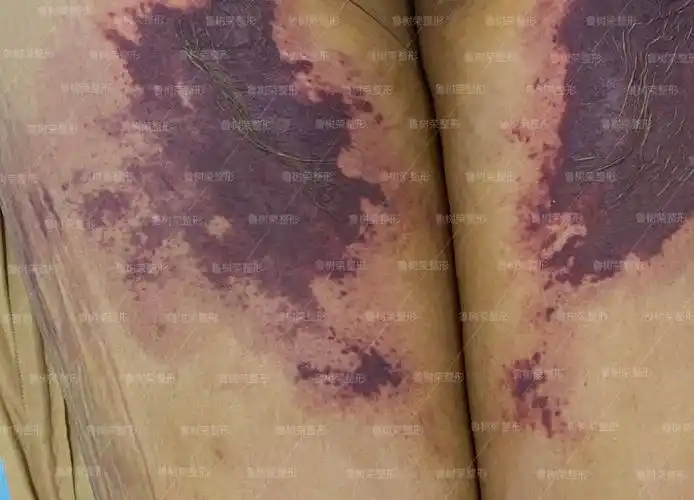 吸脂手术如何避免皮肤坏死