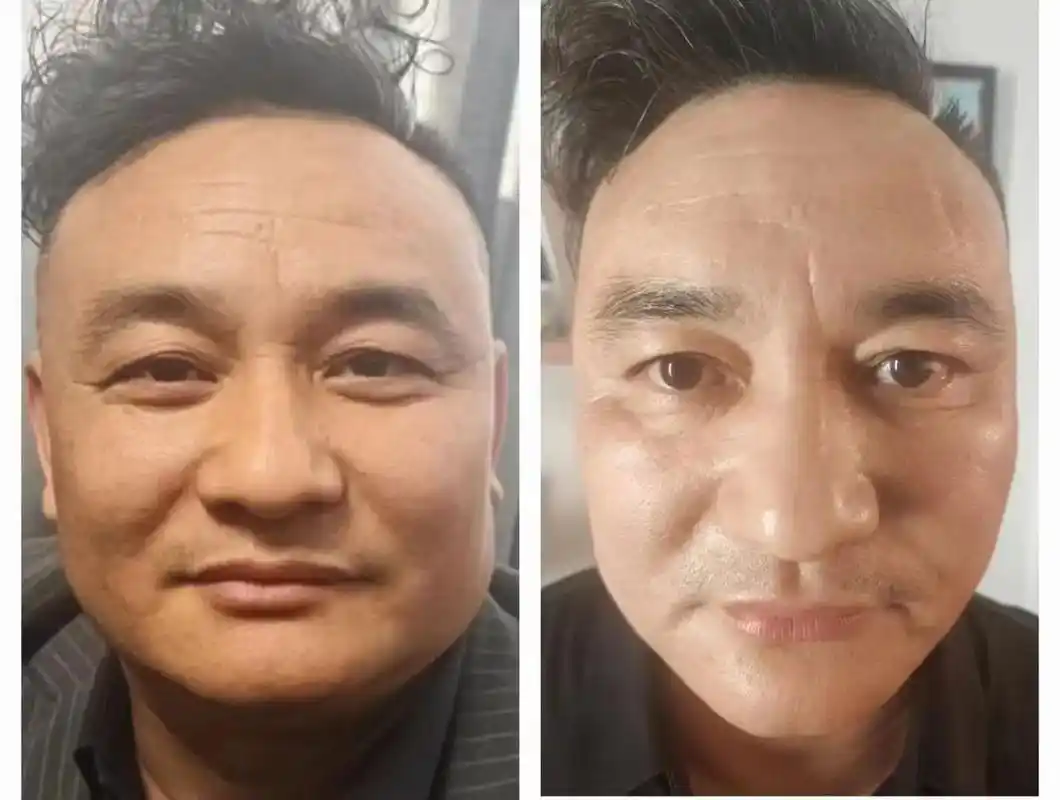 你看做过一次无针线雕的前后对比图后,你觉得哪个好看,直接大饼 - 抖