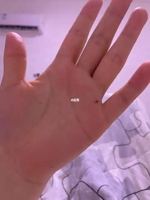 手心痣
