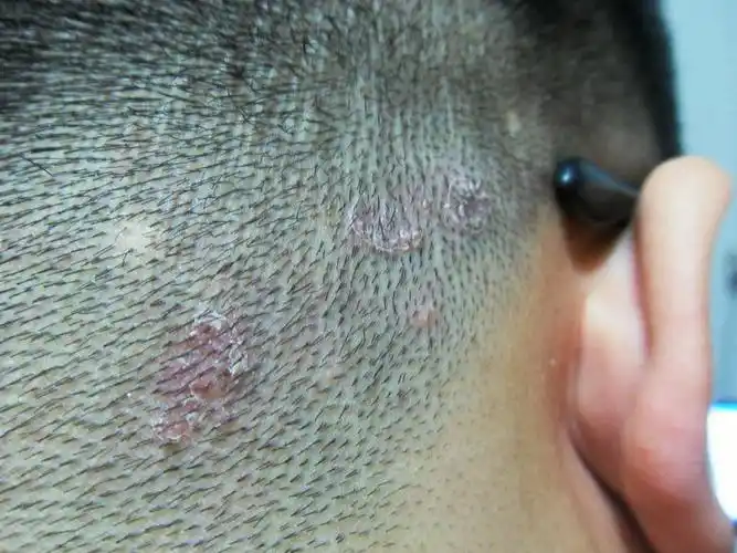 后脑勺长红点,热了就痒,请问怎么处理?