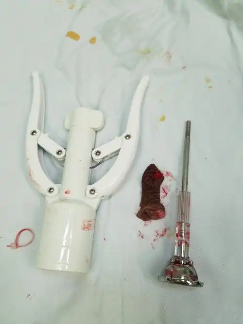 住院切割吻合器法:约2200元,在门诊的基础上加上胸片,心电图,住院3天