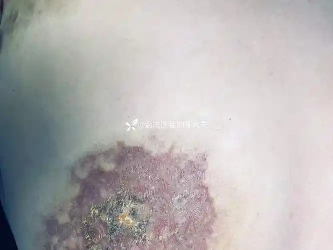 典型皮损狼疮性脂膜炎