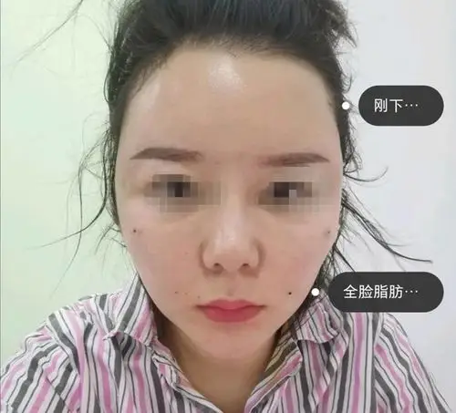 看看我脂肪填充30天恢复的照片解答各位做完脂肪填充多久可以消肿?