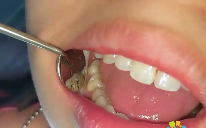 第一磨牙(大牙)单面洞树脂补牙过程_哔哩哔哩_bilibili