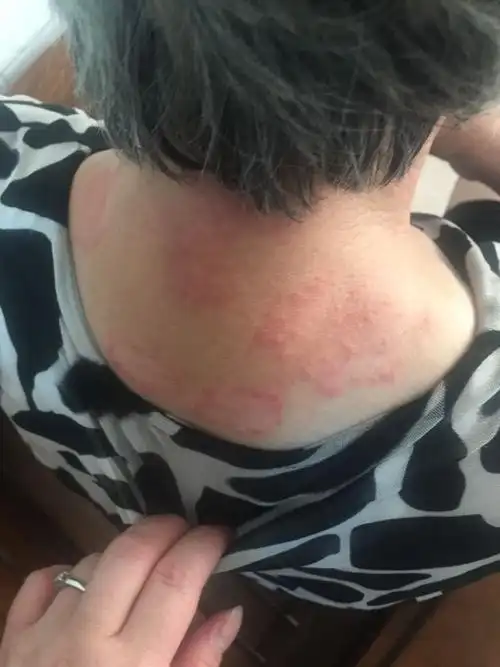 我婆婆后颈脖上长了一圈一圈的红色疹子,痒痒的,是什么情况,要怎么