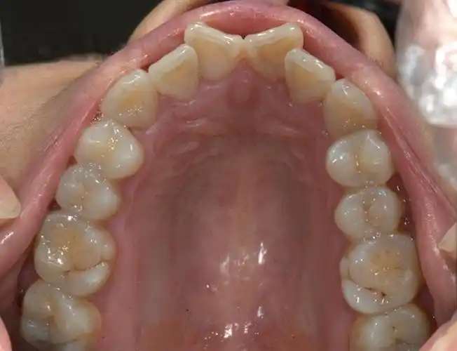 上牙列牙颌面照片