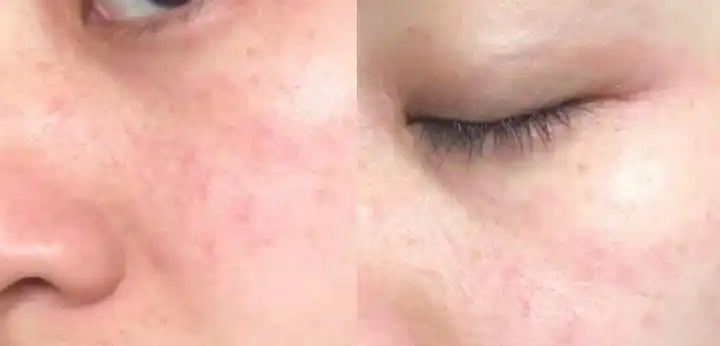 皮肤敏感脆弱,该怎么修复自己的皮肤屏障?