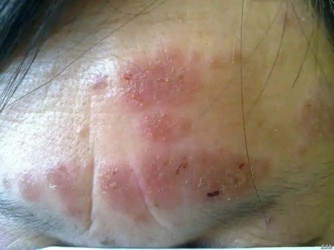 看图识病 - 皮肤及性传播疾病讨论版 - 爱爱医医学论坛