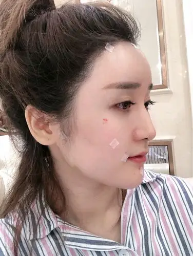 自体全脸脂肪填充第一天