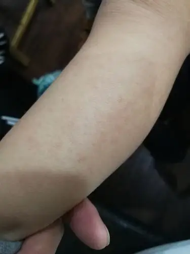 其它 手足口病案一例 写美篇下图为四诊时左侧小腿的红疹